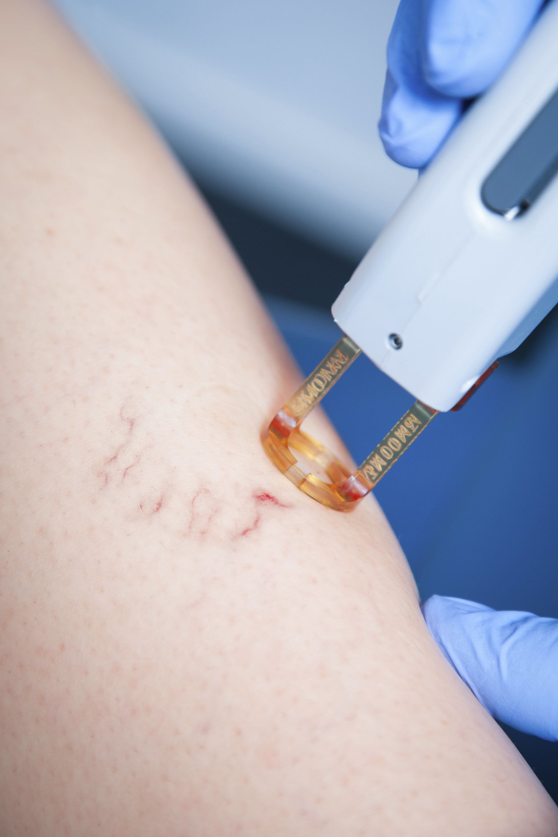 A hand-held device applied to the skin to treat a varicose vein