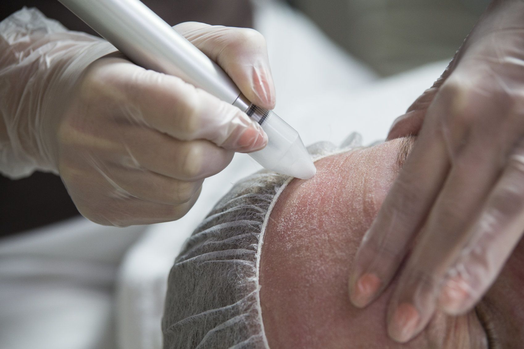 Dermabrasion device being applied to a person's forehead