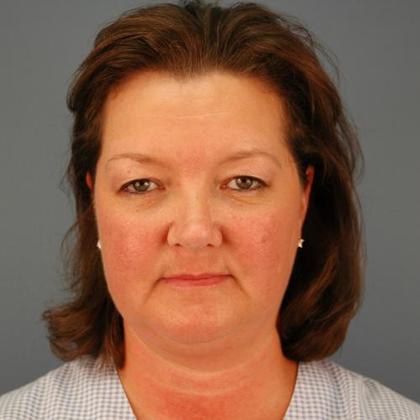 Before blepharoplasty